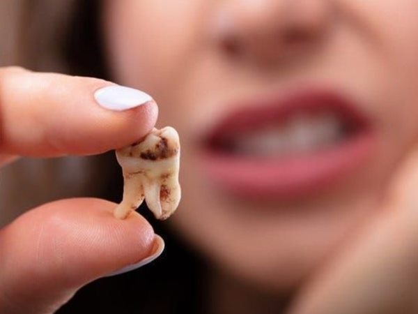 mơ thấy rụng nhiều răng 1 mơ thấy rụng nhiều răng 1