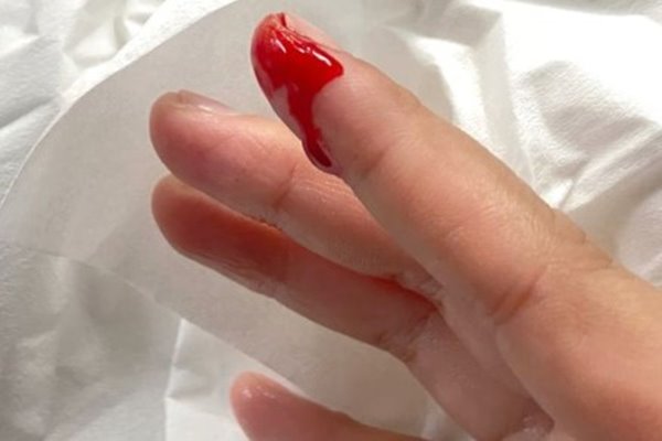 Mơ thấy đánh nhau chảy máu giải mã ý nghĩa và con số chuẩn nhất 2