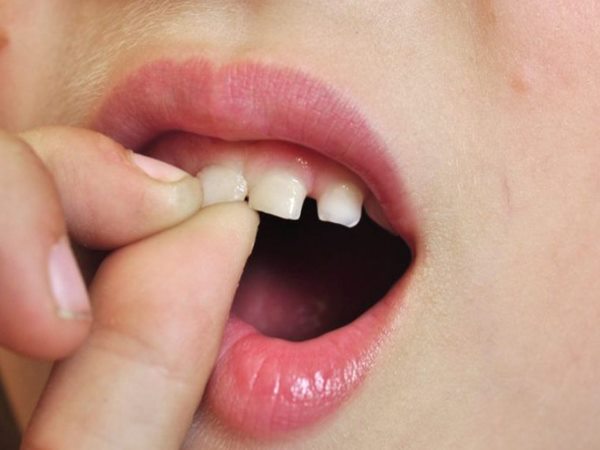 Nằm mơ thấy rụng răng không chảy máu Nằm mơ thấy rụng răng không chảy máu